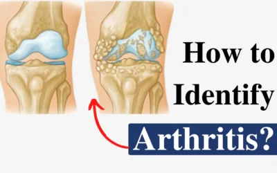 How to Identify Arthritis?