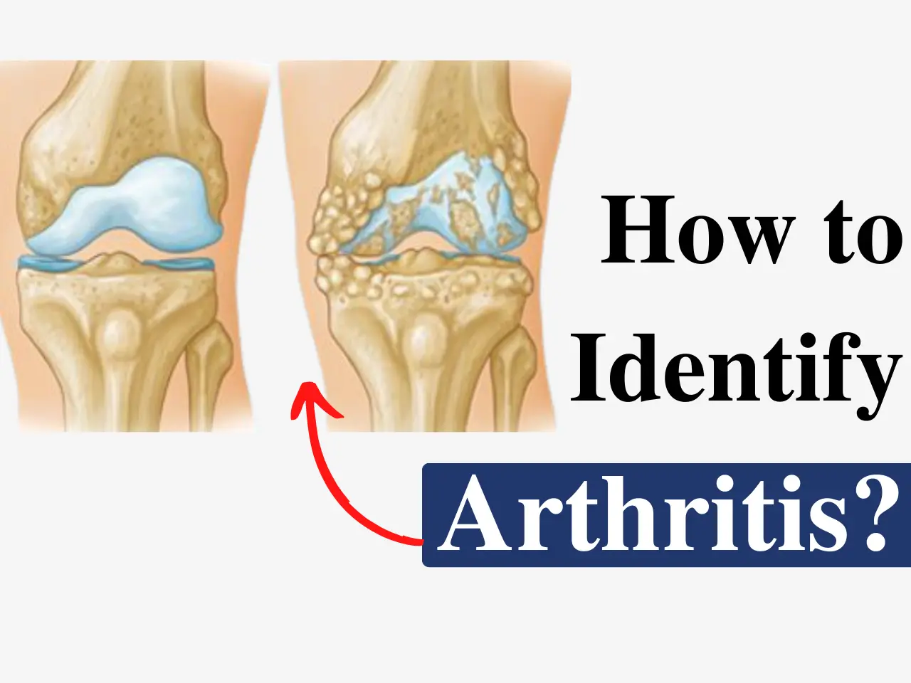 how to identify Arthritis