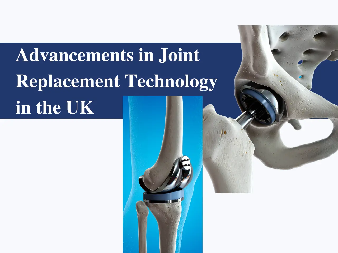 Advancements in Joint Replacement