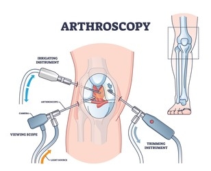 benefits of arthroscopy surgery