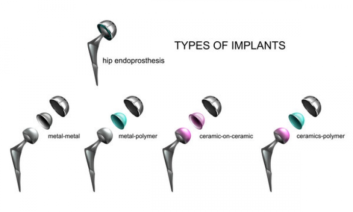 Types of hip replacement implants