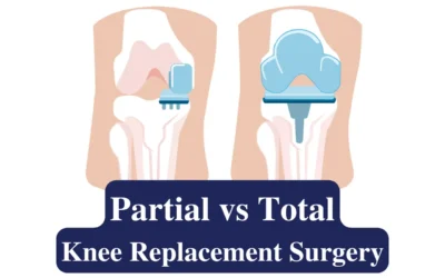 Key Differences Between Partial and Total Knee Surgery