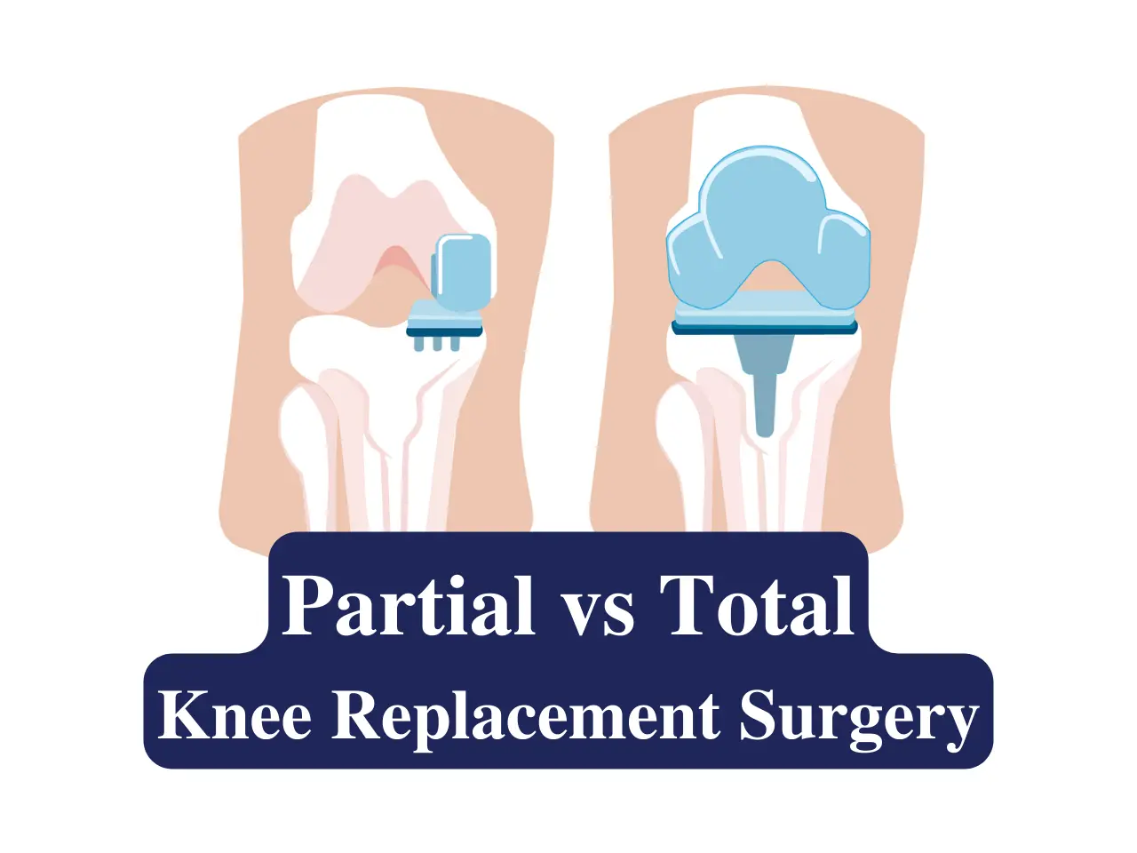 Partial vs Total Knee Replacement surgery