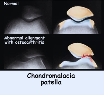 Understanding Chondromalacia Patella