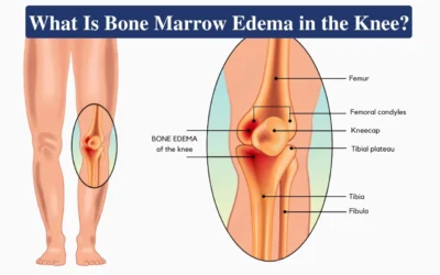 Bone Marrow Oedema in the Knee
