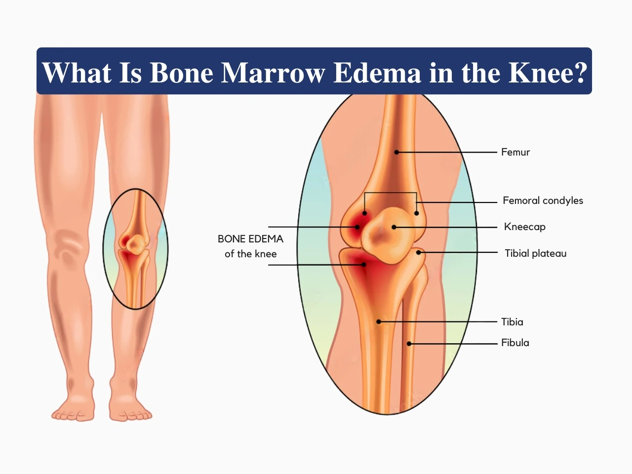 What is Bone Marrow Edema in the Knee