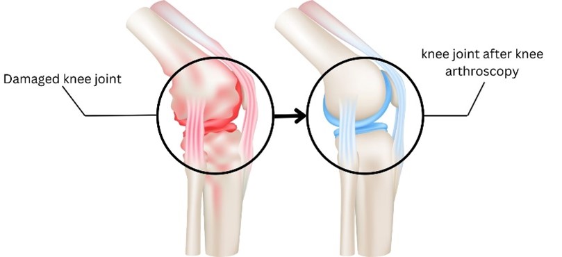 Knee Arthroplasty