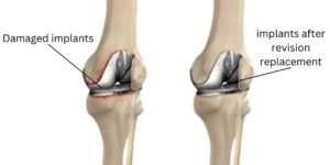 Revision Knee Replacement