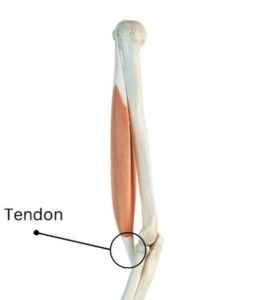 Tendinitis