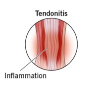 Tendonitis Inflammation