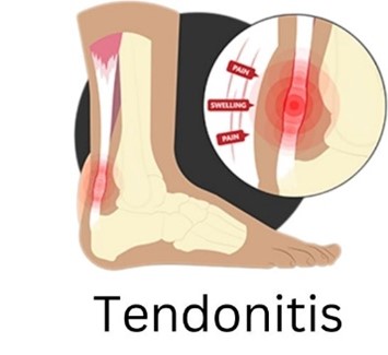 Tendonitis