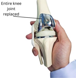 Total Knee Replacement (TKR)