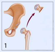 hip replacement 1st image