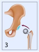 hip replacement 3rd image