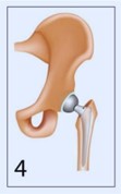 hip replacement 4th image