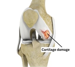 Cartilage Damage