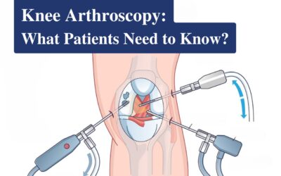 Preparing for Knee Arthroscopy: What Patients Need to Know