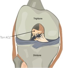 Ligament Injuries