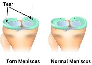 Meniscal Tears