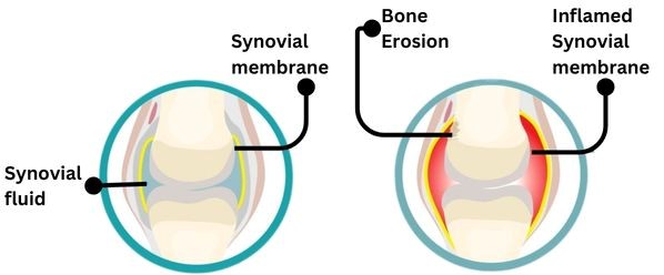 Normal Knee and Synovitis