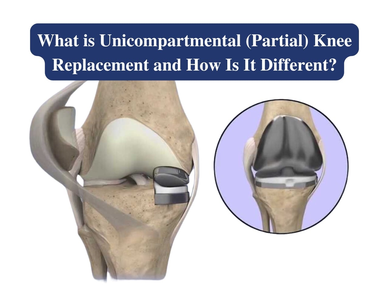 Unicompartmental Partial Knee Replacement