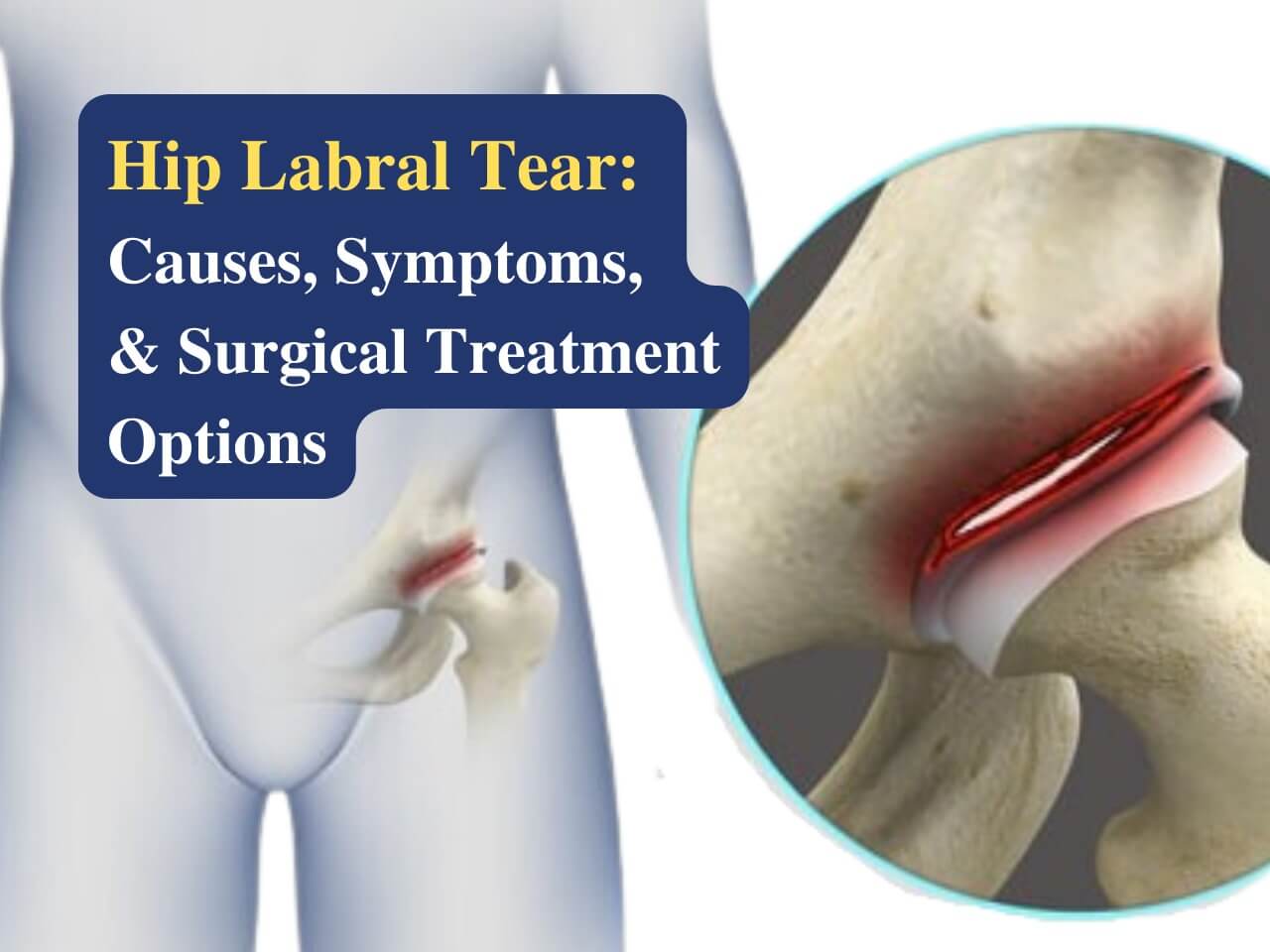 Hip Labral Tear