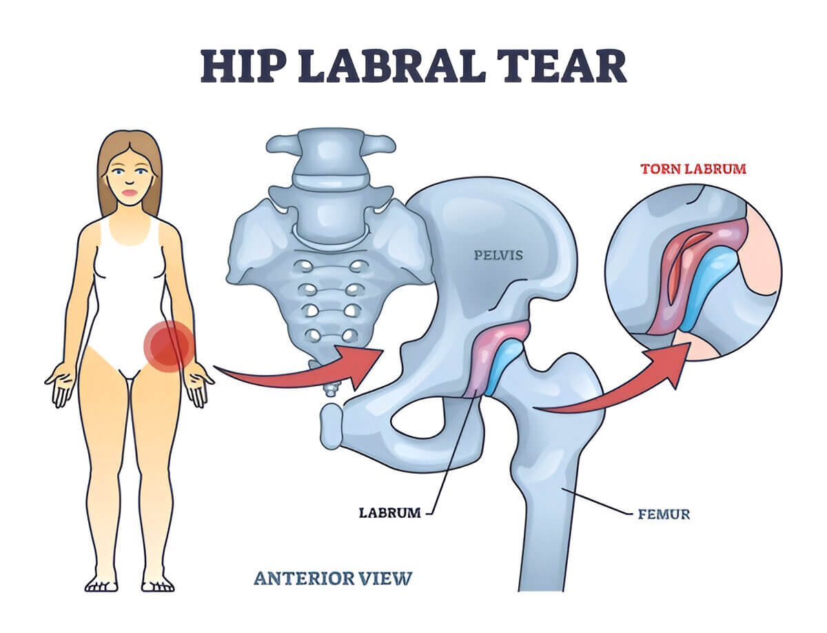 Hip Labral Tear