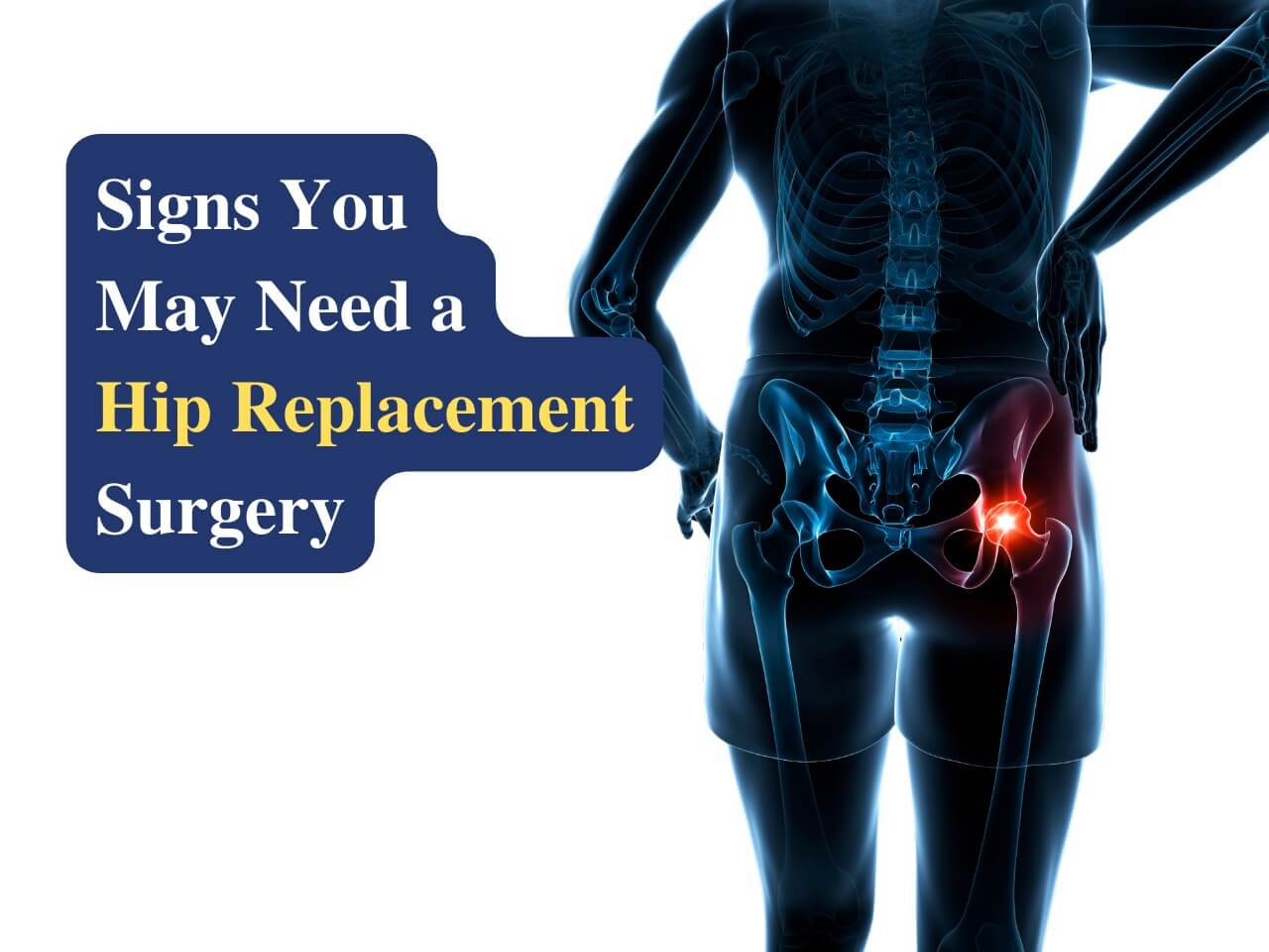 Signs you need hip replacement