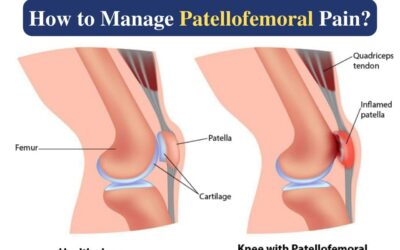 How to Manage Patellofemoral Pain?