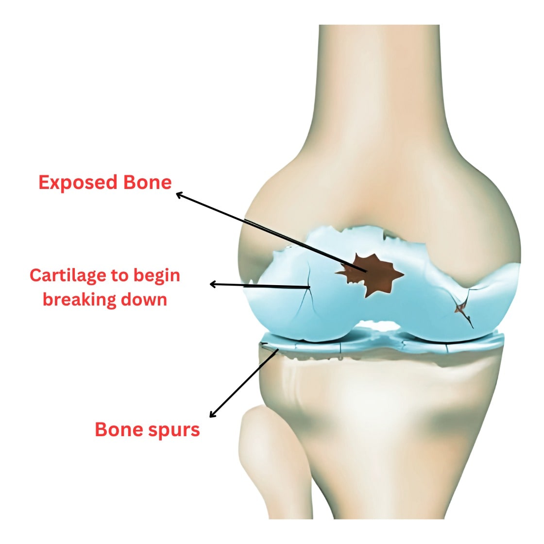 How to Manage Patellofemoral Pain