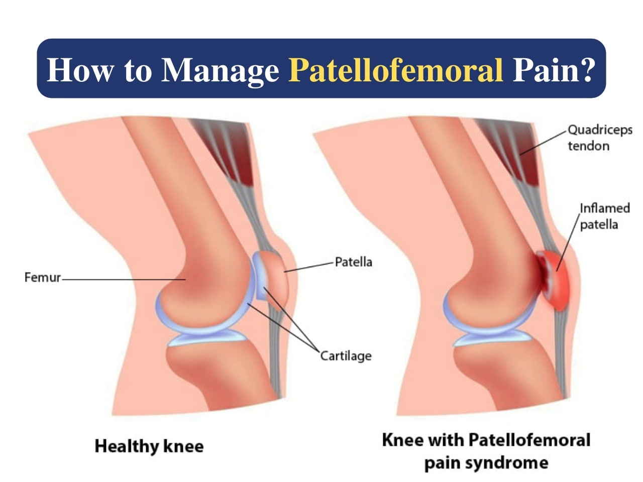 How to Manage Patellofemoral Pain