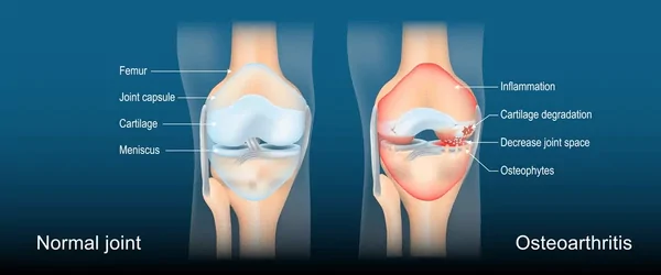 Osteoarthritis treatment