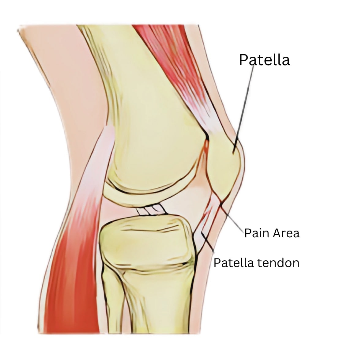 Patellar Tendinopathy