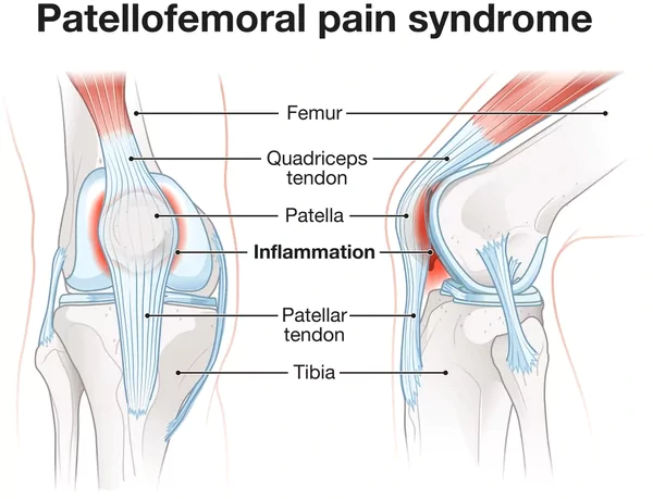 Patellofemoral Pain Syndrome