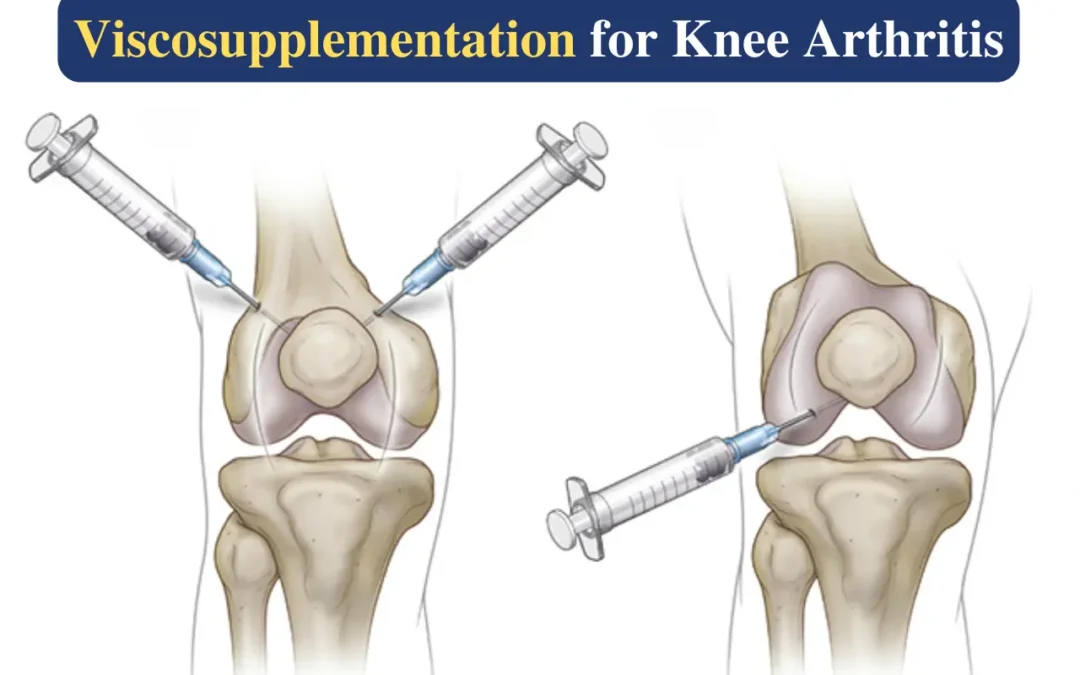 Viscosupplementation for Knee Arthritis