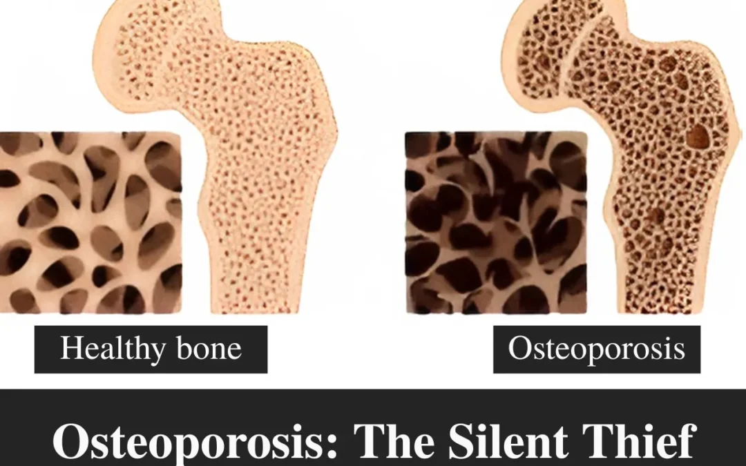 What is Osteoporosis: Causes, Risk Factors, Prevention & Treatments