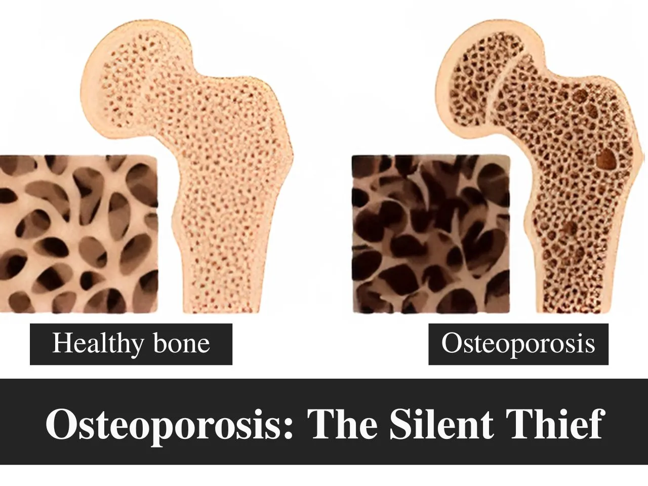 Osteoporosis