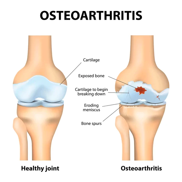 What is Knee Osteoarthritis What is Knee Osteoarthritis