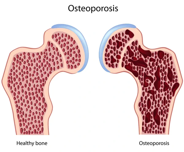 What is Osteoporosis What is Osteoporosis