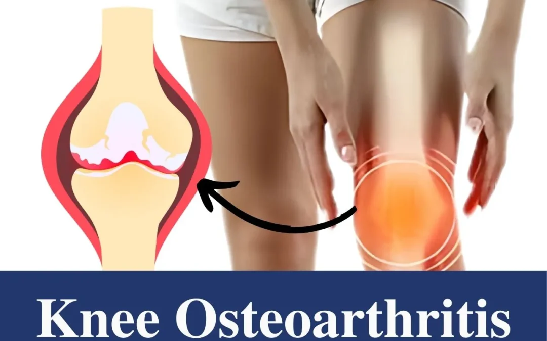 Knee Osteoarthritis: Symptoms, Causes and Effective Treatment