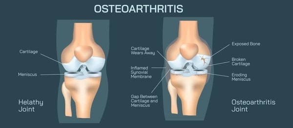 Knee Osteoarthritis Symptoms