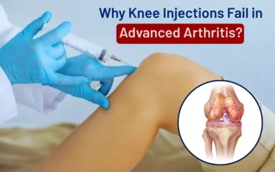 Why Knee Injections Fail in Advanced Arthritis?