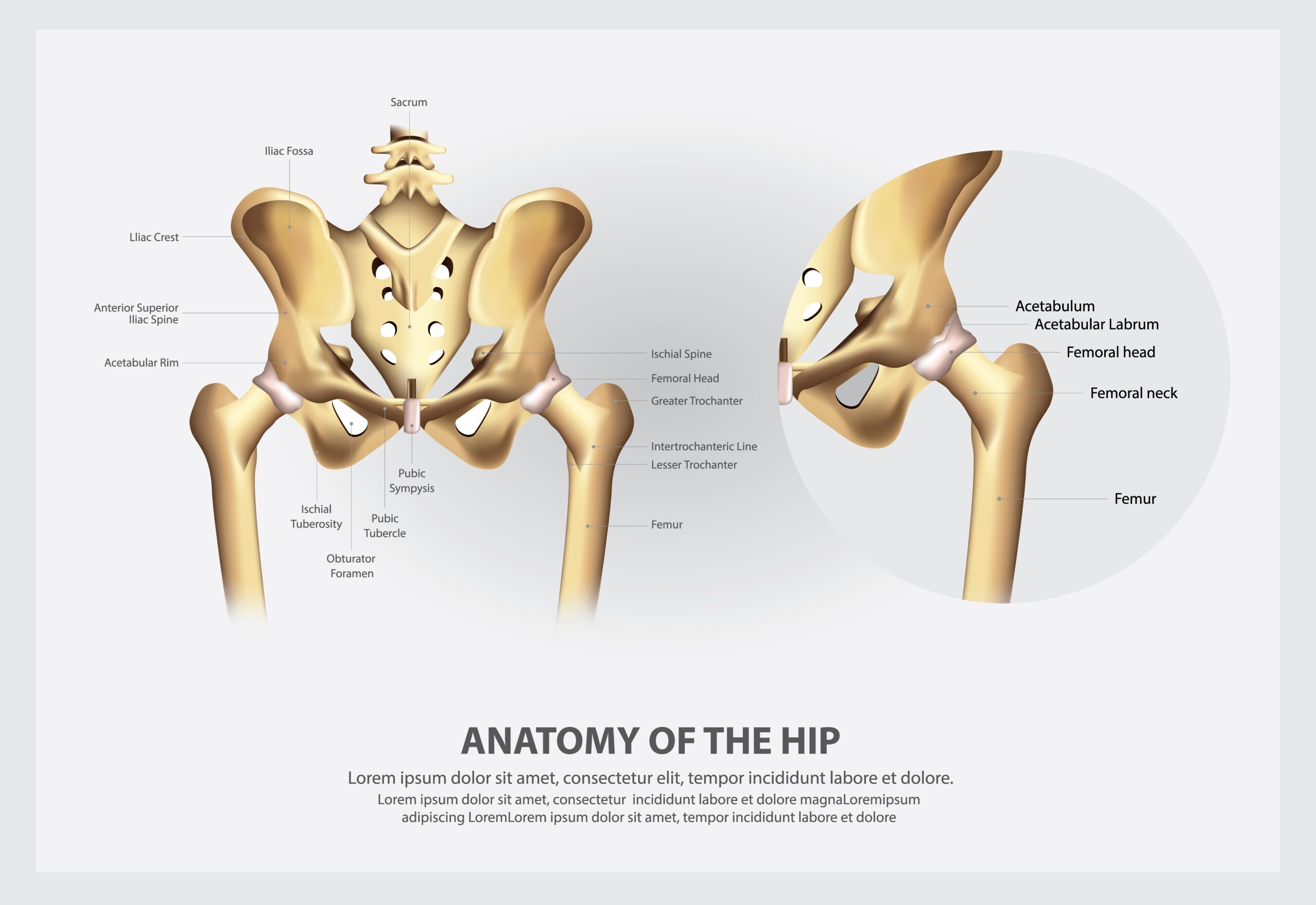 Hip Replacement