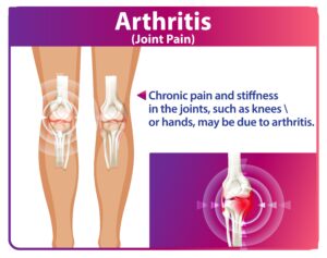 Knee Arthritis