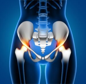 Bilateral Total Hip Replacement?