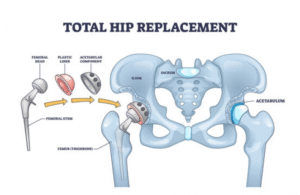 Total Hip Replacement?